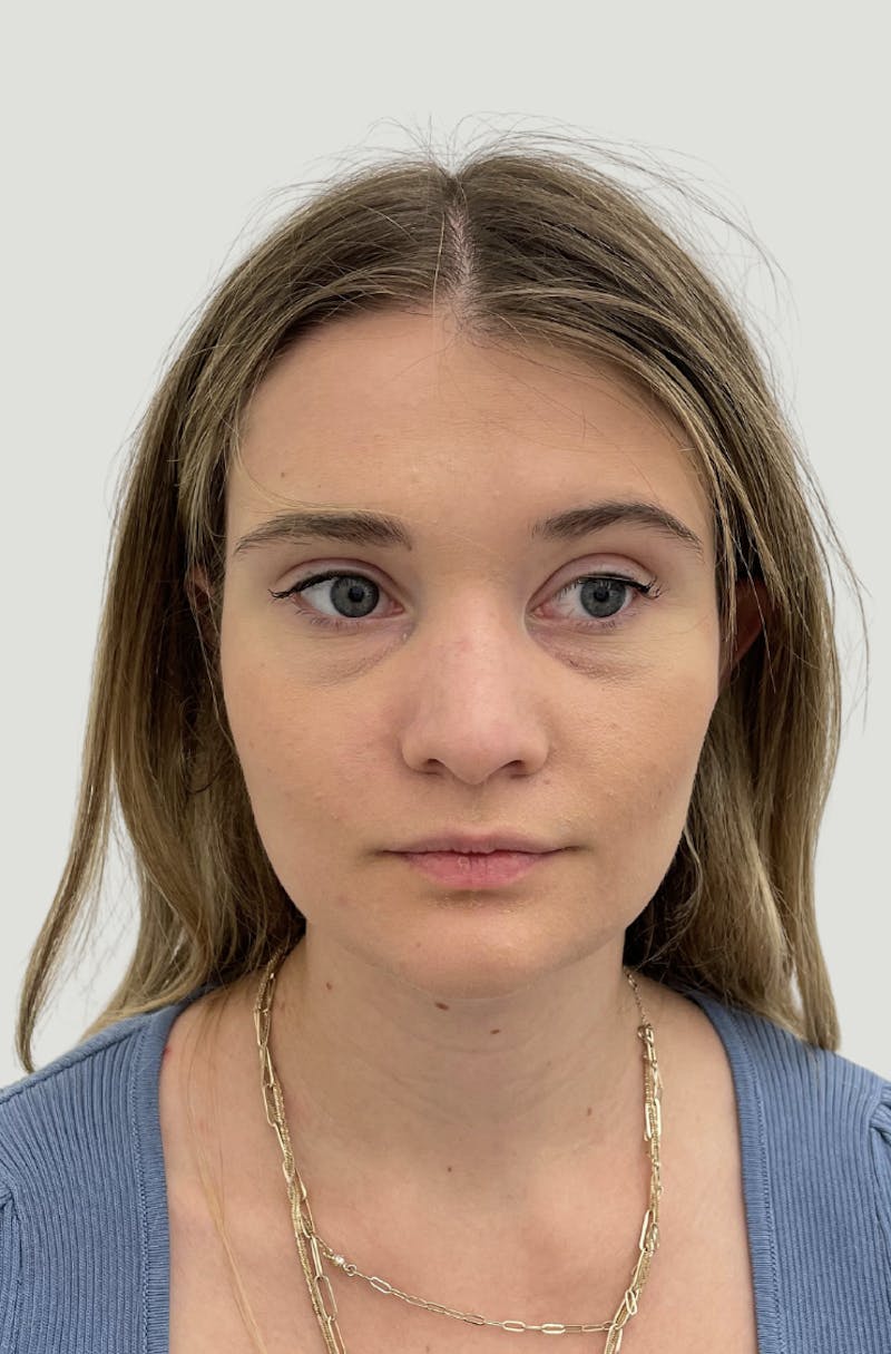 Rhinoplasty Before & After Gallery - Patient 104016 - Image 1