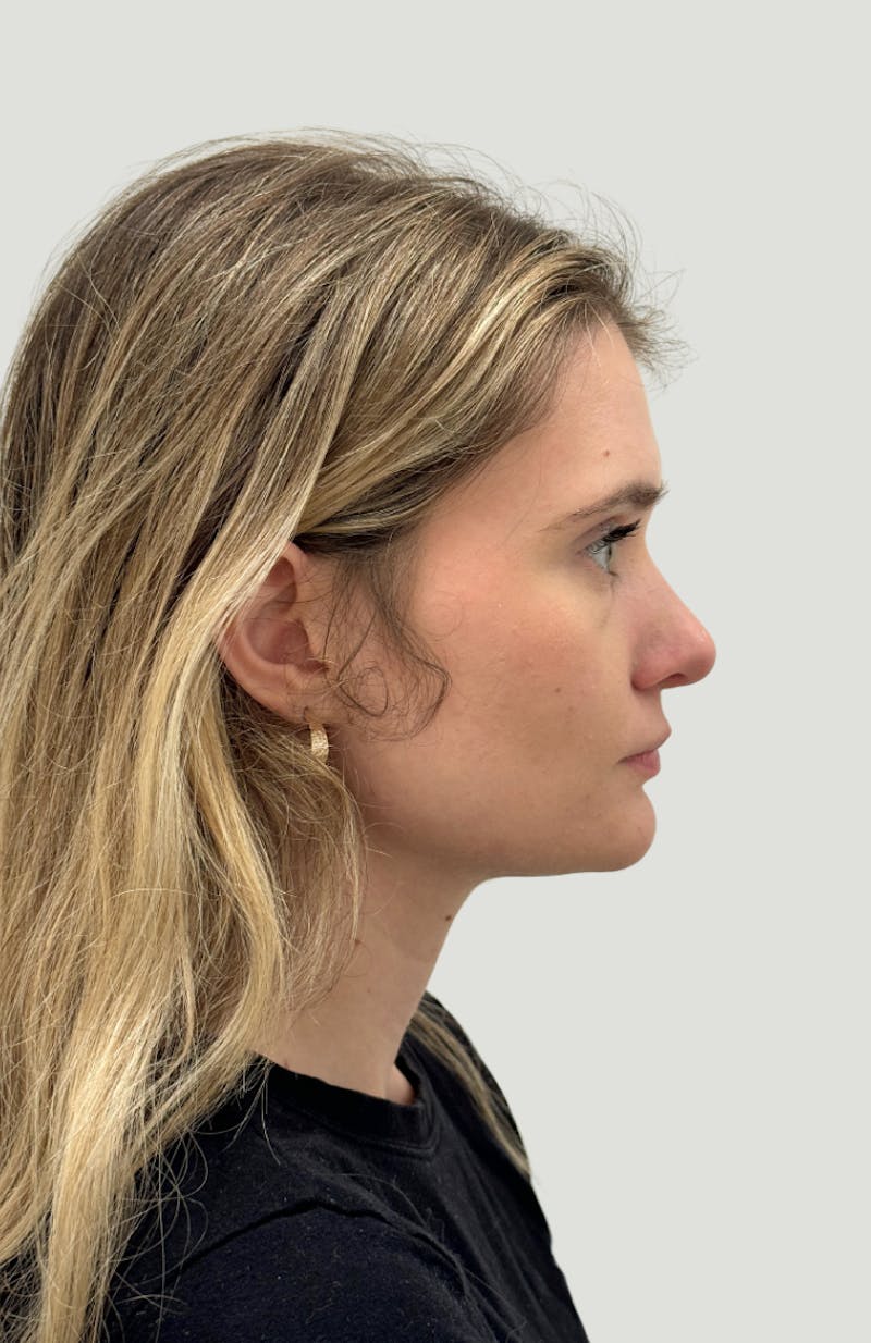 Rhinoplasty Before & After Gallery - Patient 104016 - Image 6