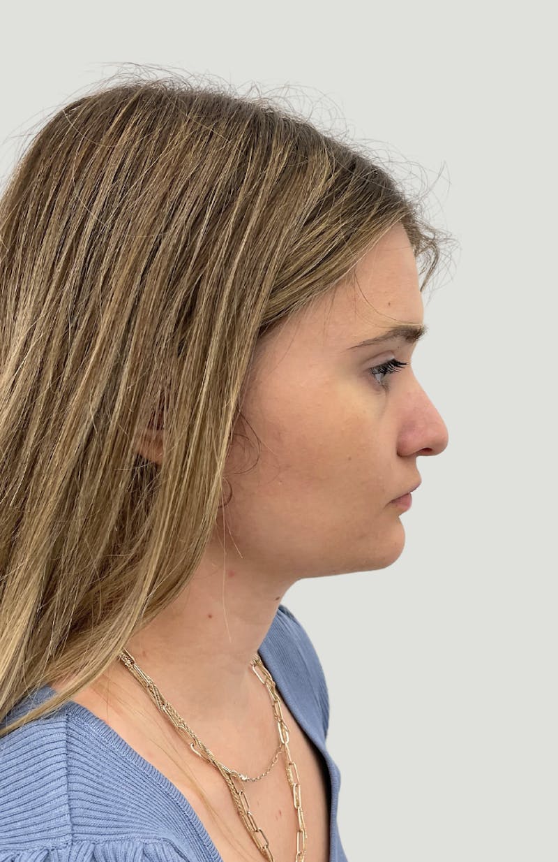 Rhinoplasty Before & After Gallery - Patient 104016 - Image 5