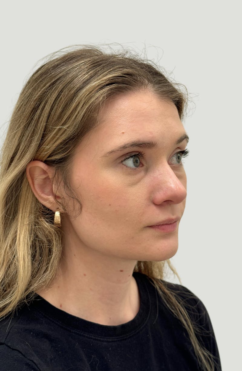 Rhinoplasty Before & After Gallery - Patient 104016 - Image 4