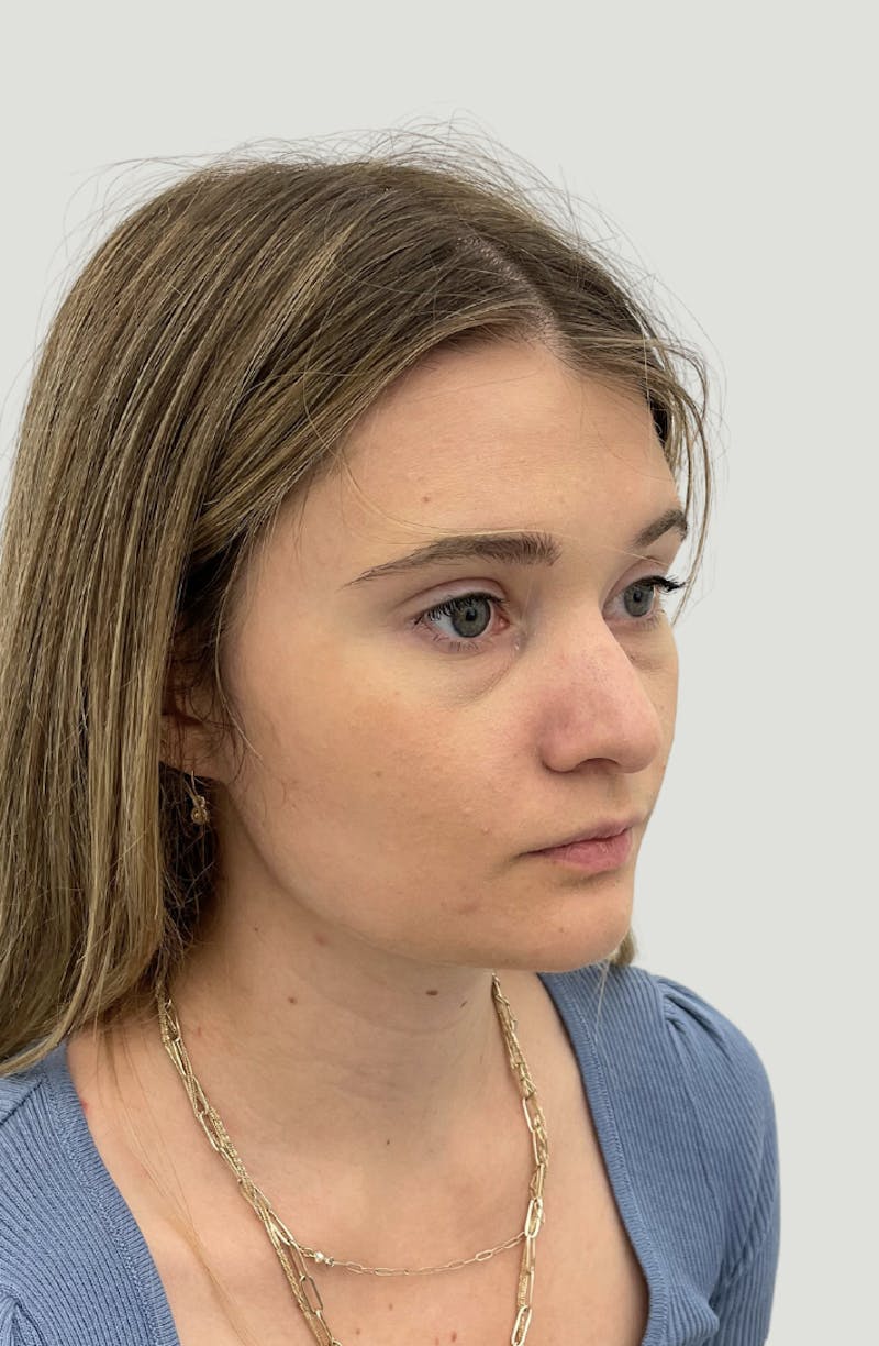 Rhinoplasty Before & After Gallery - Patient 104016 - Image 3