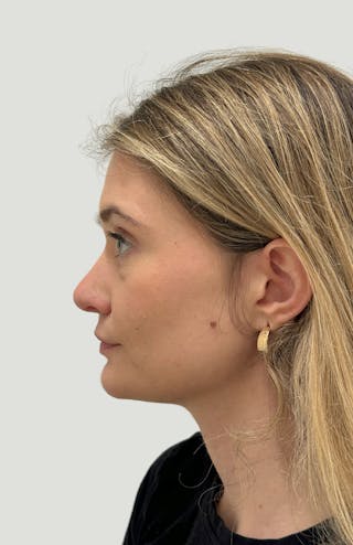 Rhinoplasty Before & After Gallery - Patient 104016 - Image 10