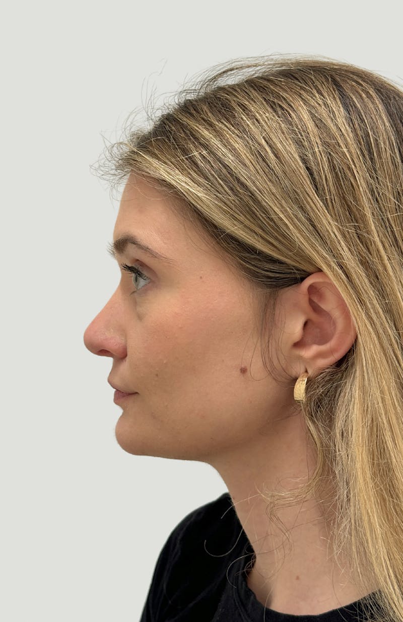 Rhinoplasty Before & After Gallery - Patient 104016 - Image 10