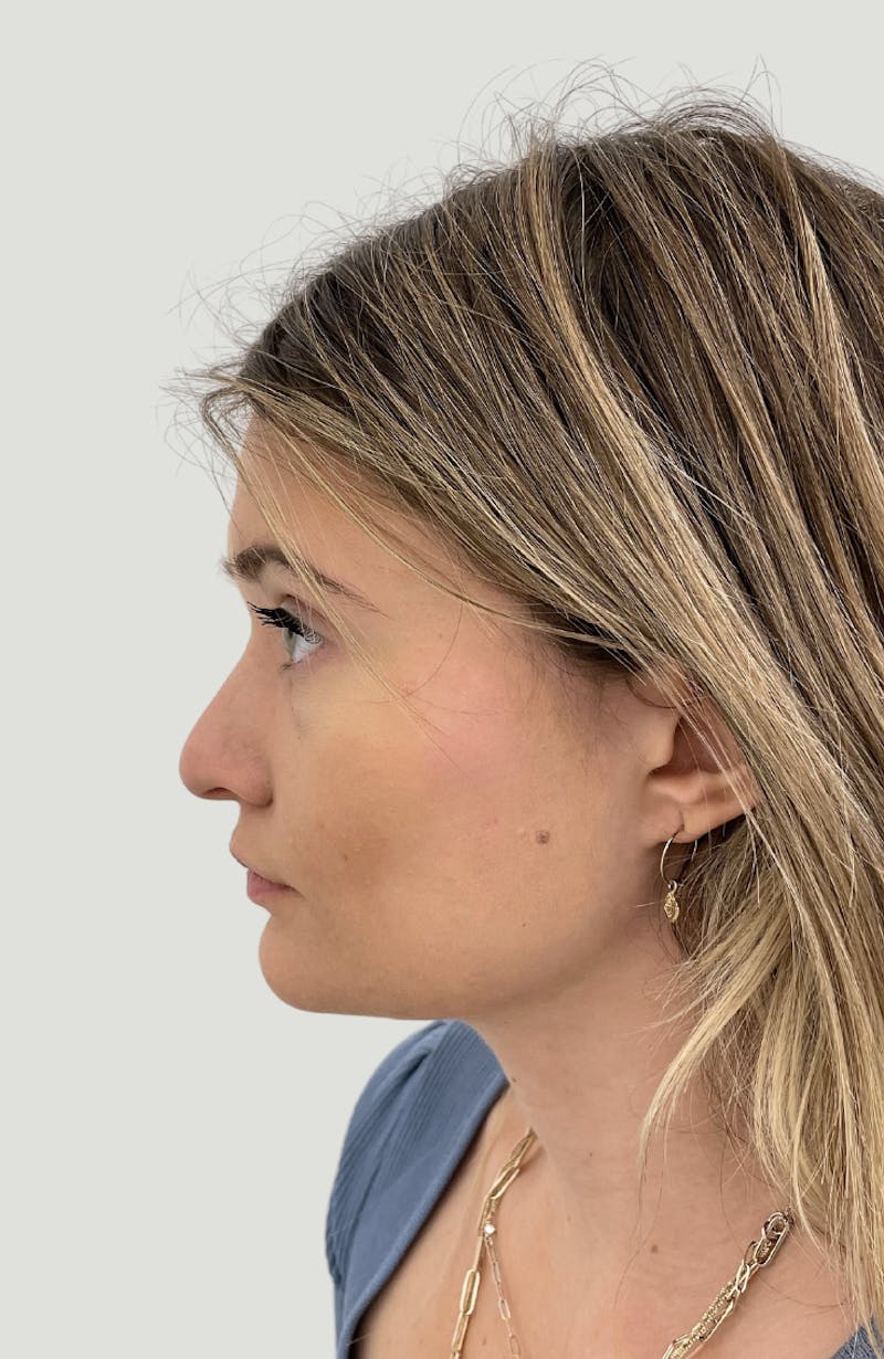 Rhinoplasty Before & After Gallery - Patient 104016 - Image 9
