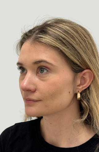 Rhinoplasty Before & After Gallery - Patient 104016 - Image 8
