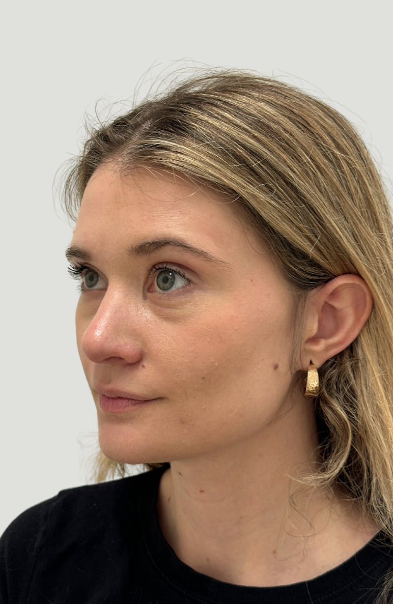 Rhinoplasty Before & After Gallery - Patient 104016 - Image 8