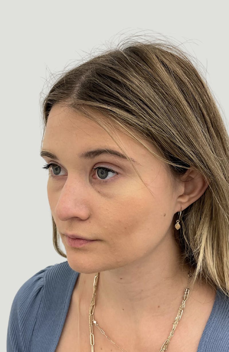 Rhinoplasty Before & After Gallery - Patient 104016 - Image 7