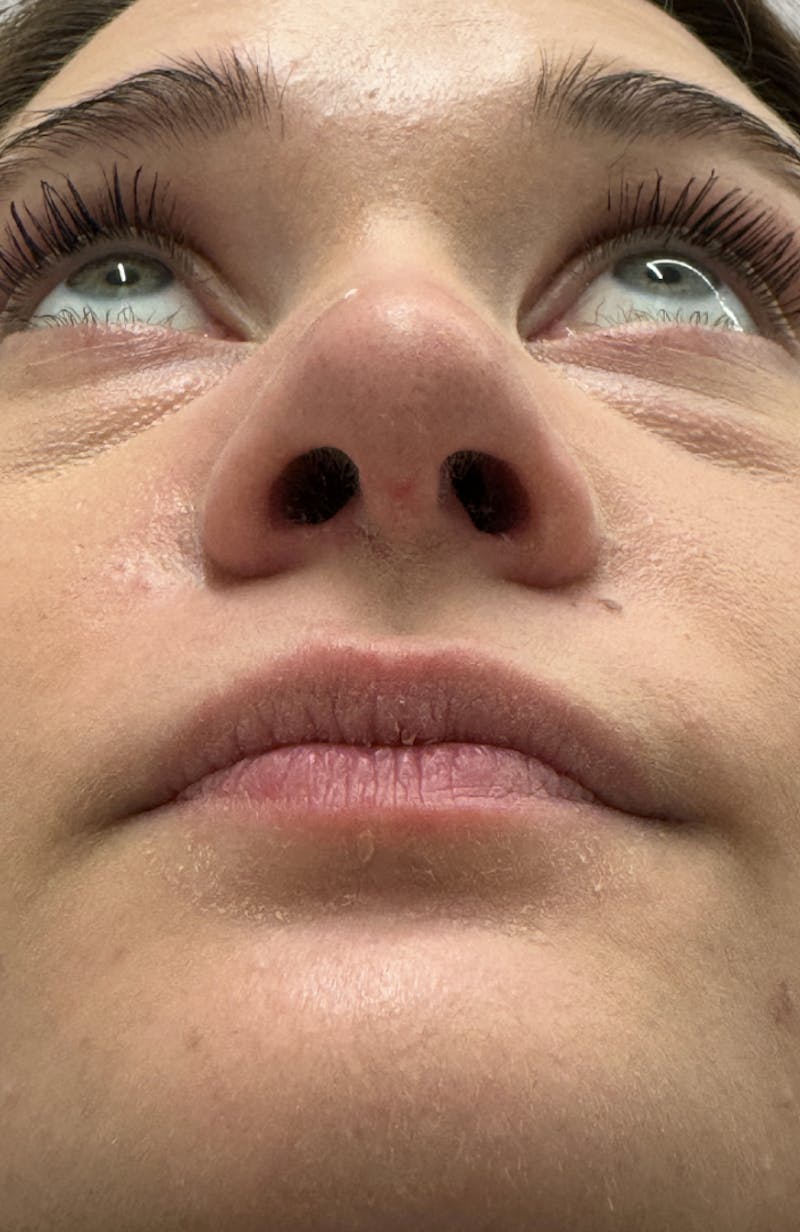Rhinoplasty Before & After Gallery - Patient 104016 - Image 12