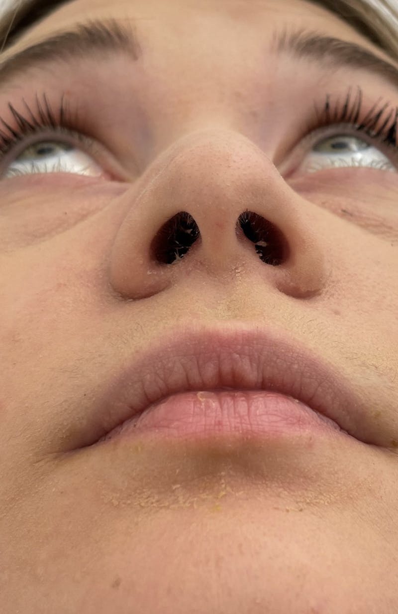 Rhinoplasty Before & After Gallery - Patient 104016 - Image 11