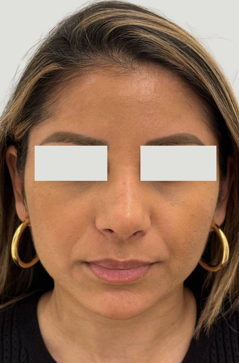 Rhinoplasty Before & After Gallery - Patient 367839 - Image 2