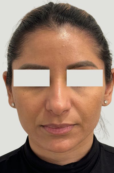 Rhinoplasty Before & After Gallery - Patient 367839 - Image 1