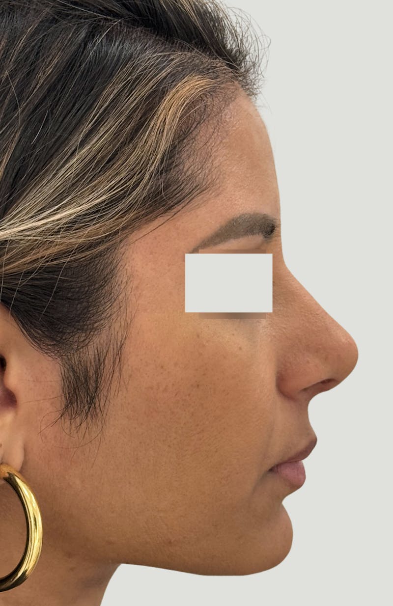 Rhinoplasty Before & After Gallery - Patient 367839 - Image 4