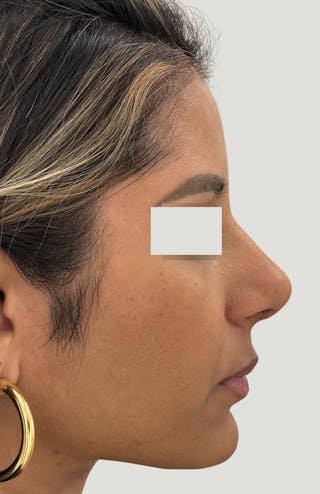 Rhinoplasty Before & After Gallery - Patient 367839 - Image 4