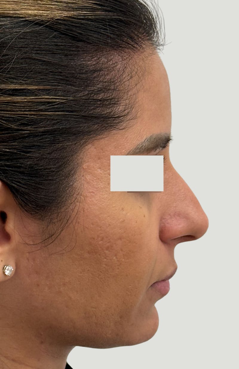 Rhinoplasty Before & After Gallery - Patient 367839 - Image 3