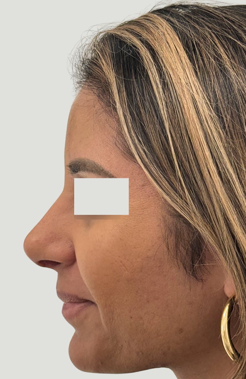 Rhinoplasty Before & After Gallery - Patient 367839 - Image 6