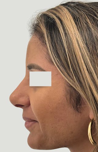 Rhinoplasty Before & After Gallery - Patient 367839 - Image 6