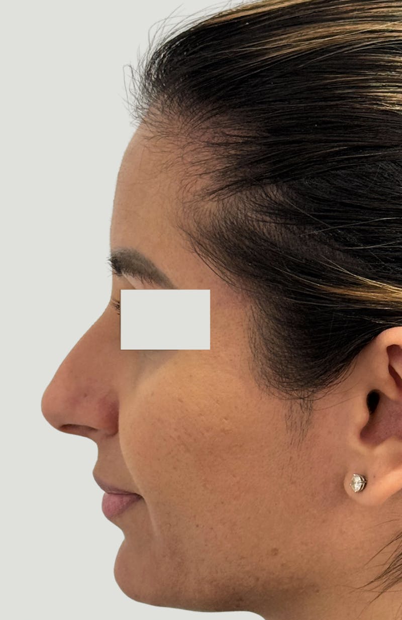 Rhinoplasty Before & After Gallery - Patient 367839 - Image 5