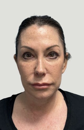 Facelift Before & After Gallery - Patient 406474 - Image 2