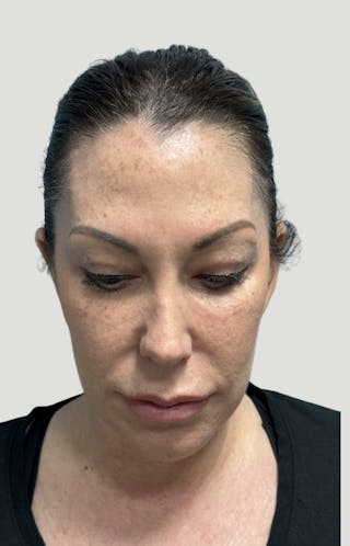 Facelift Before & After Gallery - Patient 406474 - Image 4