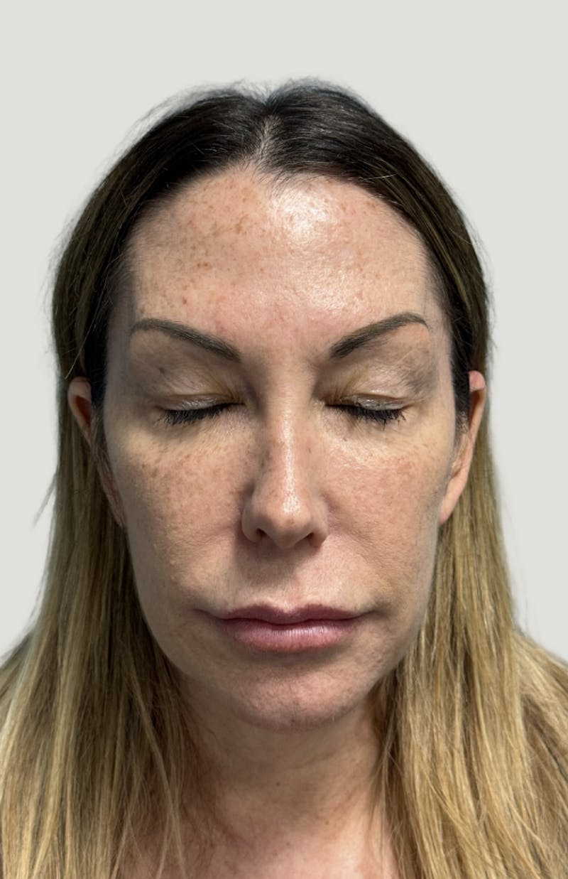 Facelift Before & After Gallery - Patient 406474 - Image 3