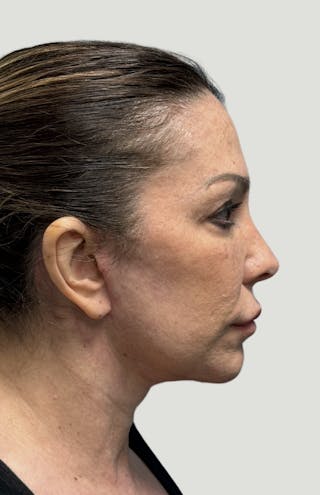 Facelift Before & After Gallery - Patient 406474 - Image 6