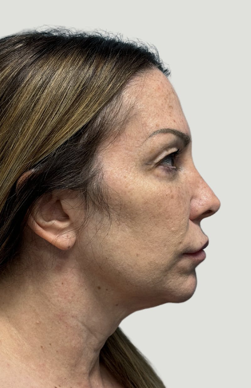 Facelift Before & After Gallery - Patient 406474 - Image 5