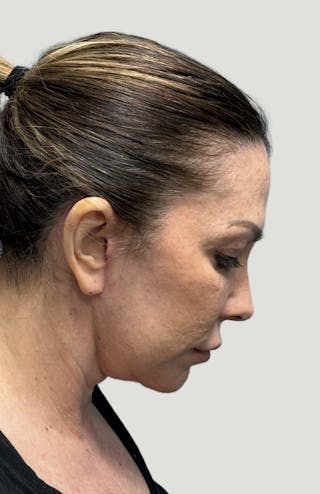 Facelift Before & After Gallery - Patient 406474 - Image 8