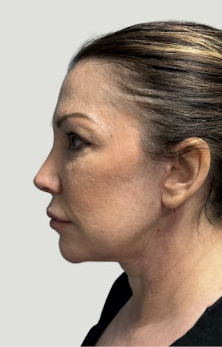 Facelift Before & After Gallery - Patient 406474 - Image 10