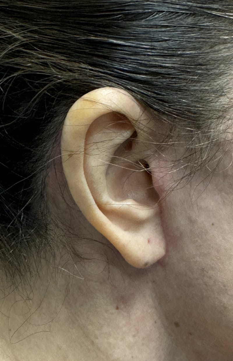 Facelift Before & After Gallery - Patient 406474 - Image 11