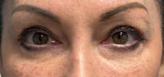 Blepharoplasty Before & After Gallery - Patient 273845 - Image 2