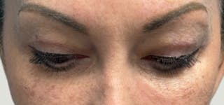 Blepharoplasty Before & After Gallery - Patient 273845 - Image 4