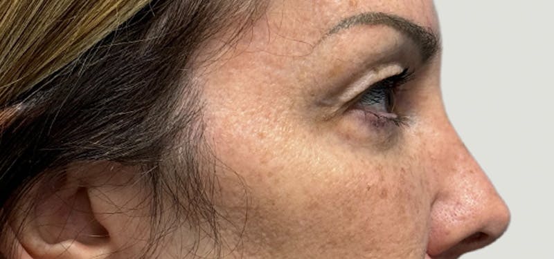 Blepharoplasty Before & After Gallery - Patient 273845 - Image 5