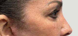Blepharoplasty Before & After Gallery - Patient 273845 - Image 6