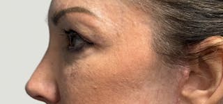 Blepharoplasty Before & After Gallery - Patient 273845 - Image 8
