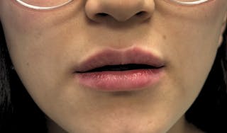 Lip Augmentation Before & After Gallery - Patient 224002 - Image 2