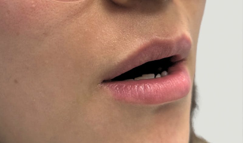 Lip Augmentation Before & After Gallery - Patient 224002 - Image 3