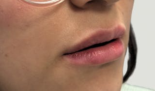 Lip Augmentation Before & After Gallery - Patient 224002 - Image 4