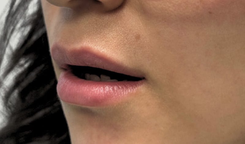Lip Augmentation Before & After Gallery - Patient 224002 - Image 5