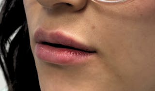 Lip Augmentation Before & After Gallery - Patient 224002 - Image 6