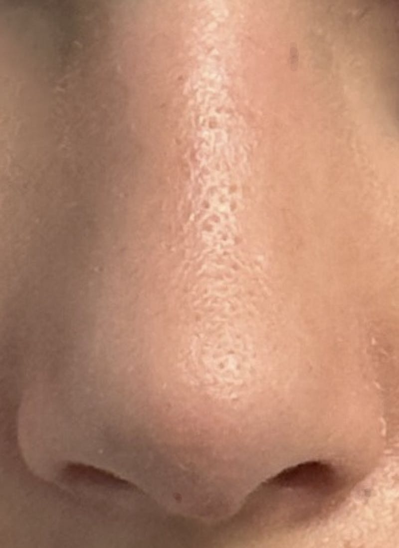Rhinoplasty Before & After Gallery - Patient 106401 - Image 2