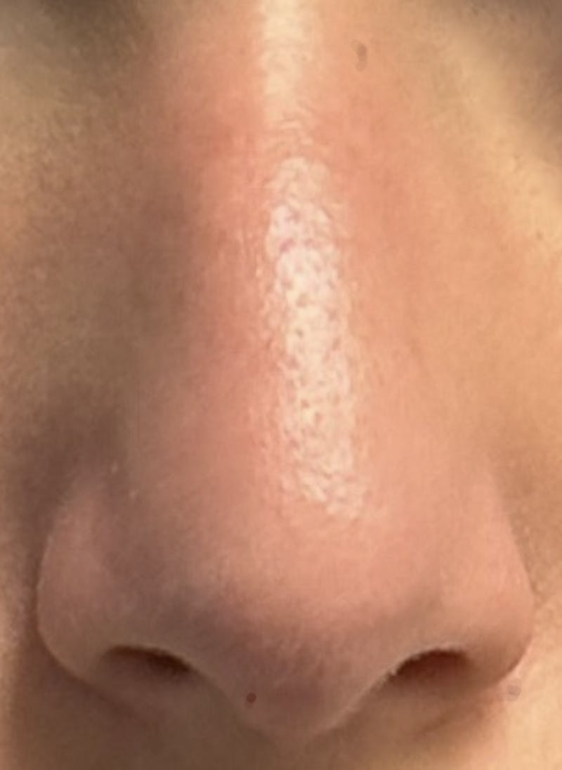 Rhinoplasty Before & After Gallery - Patient 106401 - Image 1