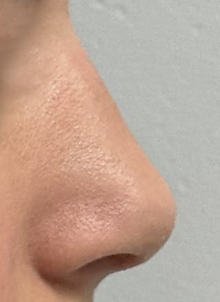 Rhinoplasty Before & After Gallery - Patient 106401 - Image 4