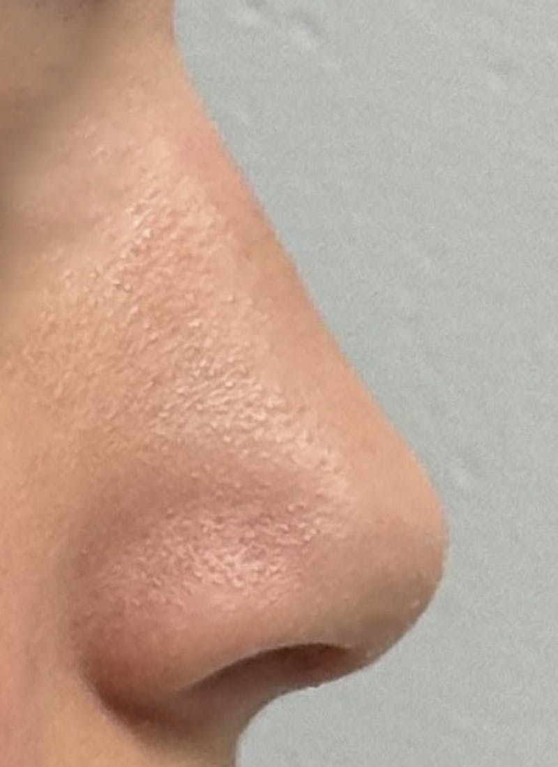 Rhinoplasty Before & After Gallery - Patient 106401 - Image 4