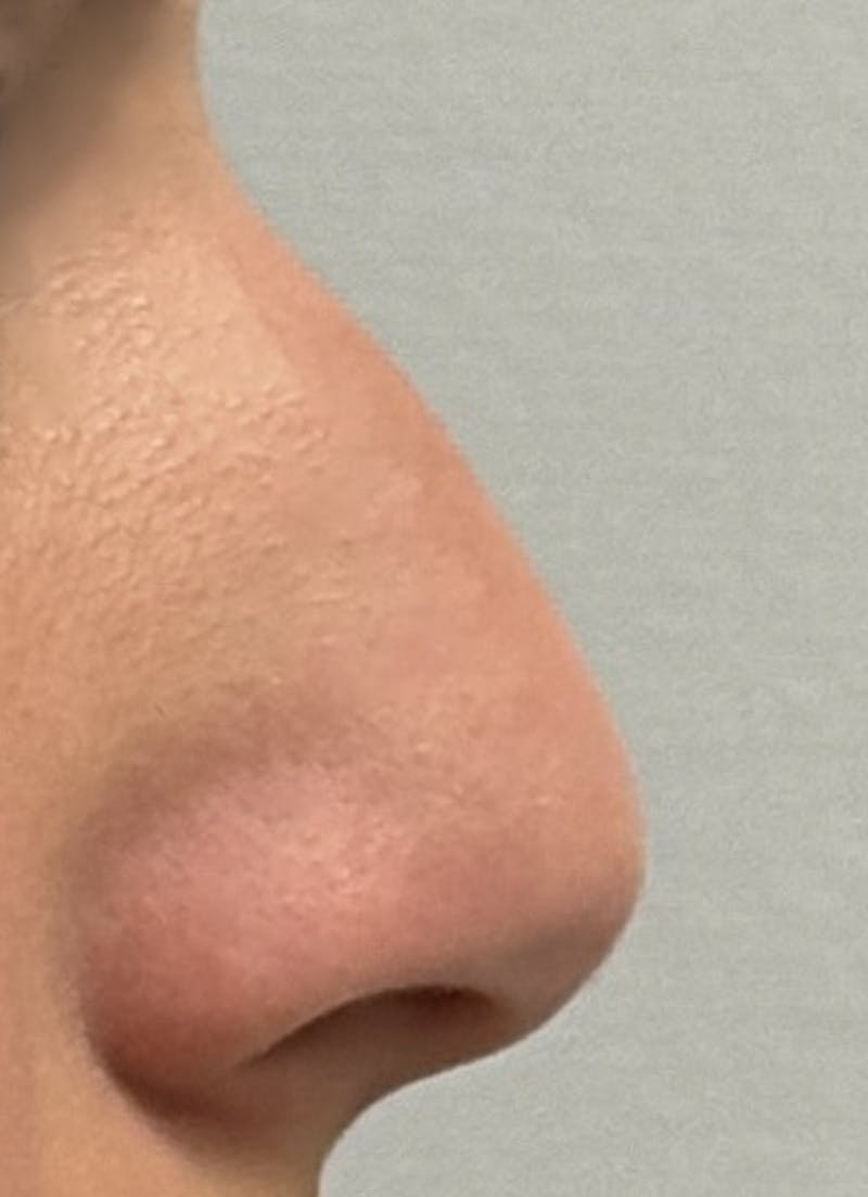 Rhinoplasty Before & After Gallery - Patient 106401 - Image 3