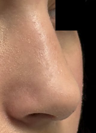 Rhinoplasty Before & After Gallery - Patient 106401 - Image 6