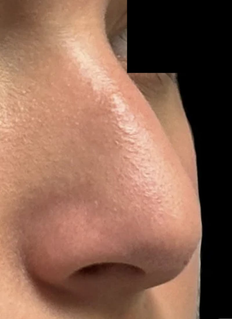 Rhinoplasty Before & After Gallery - Patient 106401 - Image 5