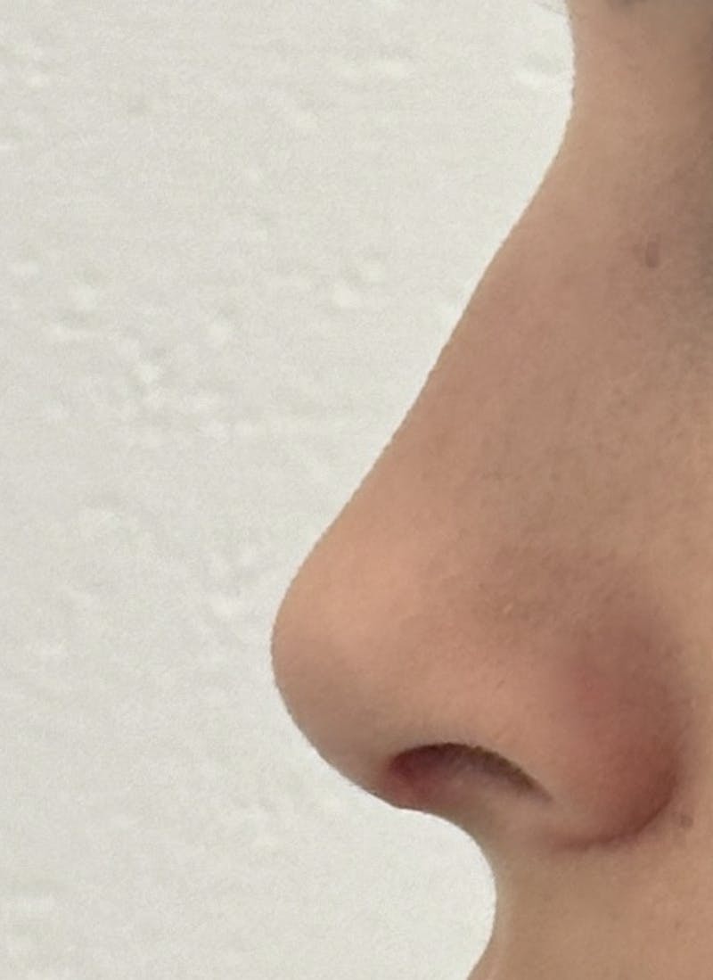 Rhinoplasty Before & After Gallery - Patient 106401 - Image 8