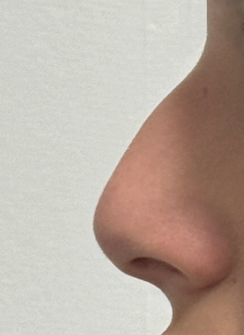 Rhinoplasty Before & After Gallery - Patient 106401 - Image 7