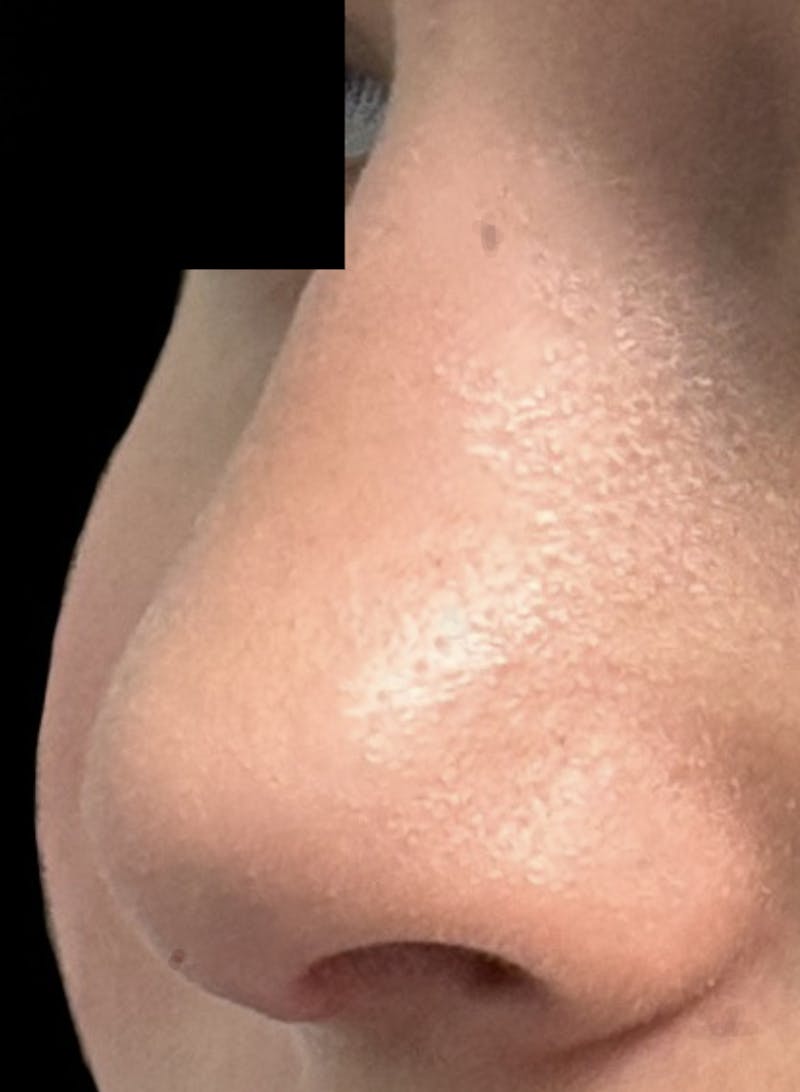 Rhinoplasty Before & After Gallery - Patient 106401 - Image 10