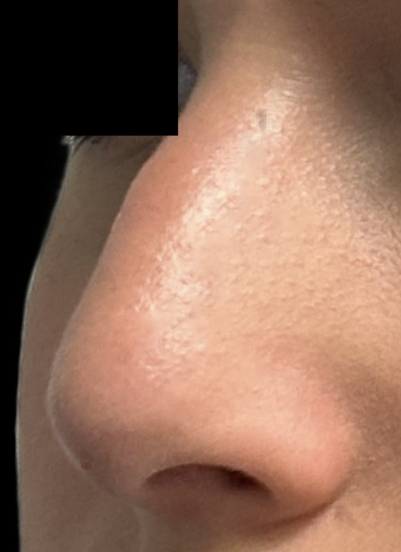 Rhinoplasty Before & After Gallery - Patient 106401 - Image 9
